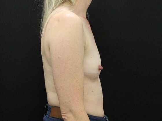 Breast Augmentation: Case 35 - Before