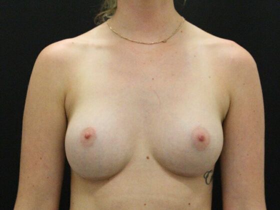 Breast Augmentation Case 36 - After
