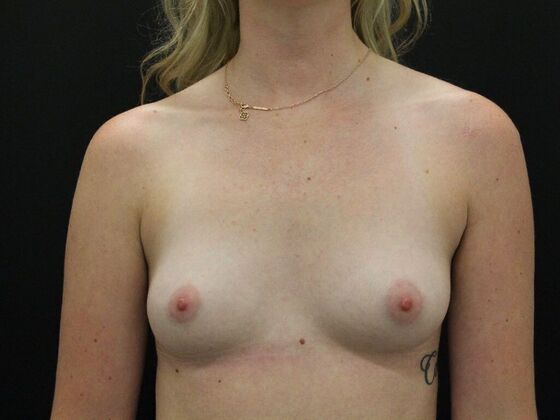 Breast Augmentation Case 36 - Before