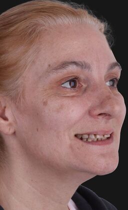 All-On-4/6: Jen_immediate fixed prosthesis - Before