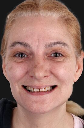 All-On-4/6: Jen_immediate fixed prosthesis - Before