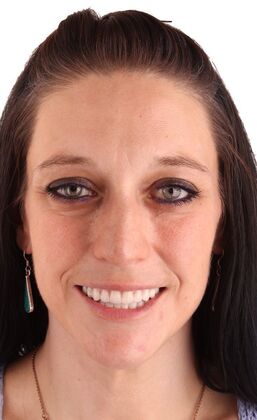 All-On-4/6: Hanna- Hybrid Fixed Plate - After