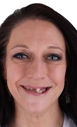 All-On-4/6: Hanna- Hybrid Fixed Plate - Before