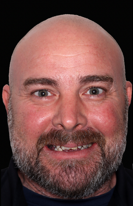 All-On-4/6: Michael T - Full Mouth implants - Before