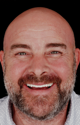 All-On-4/6: Michael T - Full Mouth implants - After