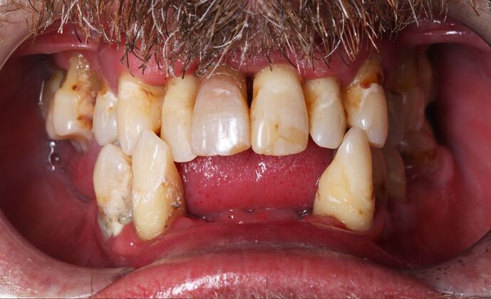 All-On-4/6: Michael T - Full Mouth implants - Before