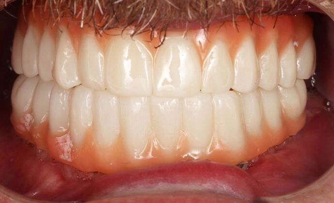 All-On-4/6: Michael T - Full Mouth implants - After