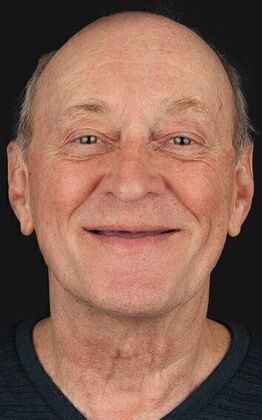 All-On-4/6: Jeff B- All_On_6 Implants - Before