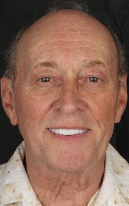 All-On-4/6: Jeff B- All_On_6 Implants - After