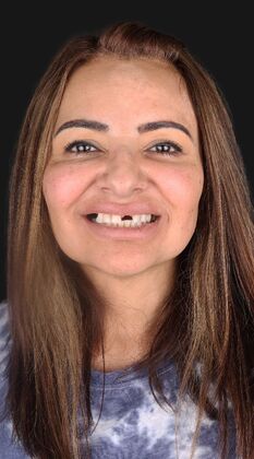 Full Mouth Restoration Karla U - Before