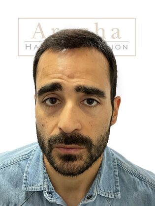 Long Hair FUE: Case 3 - Immediately post-op