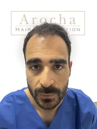 Long Hair FUE: Case 3 - Before