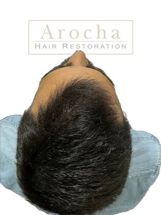 Long Hair FUE: Case 3 - Immediately post-op