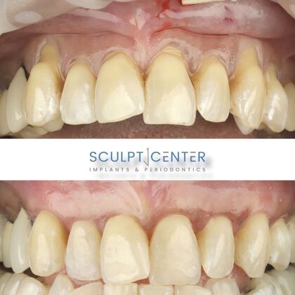 Gum Recession  Case 1