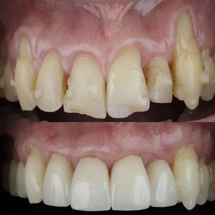 Gum Recession  Case 3