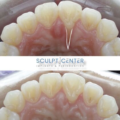 Gum Recession  Case 4