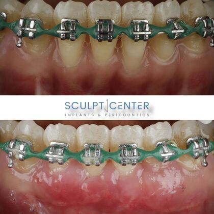 Gum Recession  Case 5