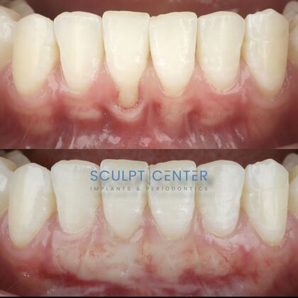 Gum Recession  Case 6