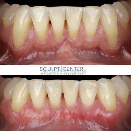 Gum Recession  Case 7