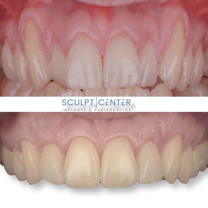 Gum Recession  Case 8