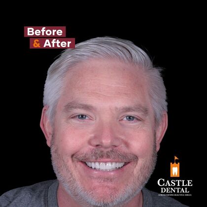 Porcelain Veneers Case 1 - After