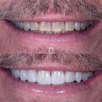 Porcelain Veneers: Case 1