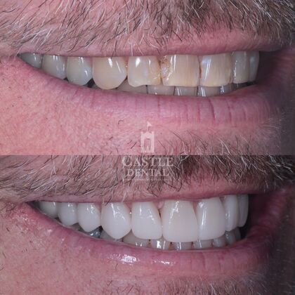 Porcelain Veneers: Case 1
