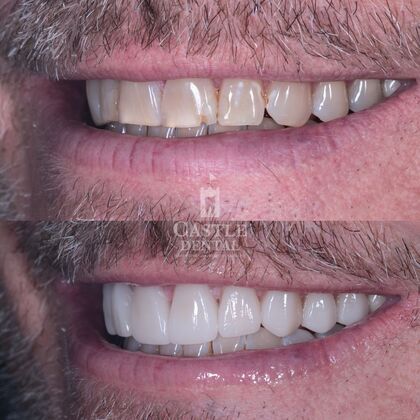 Porcelain Veneers: Case 1
