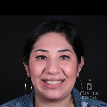 Porcelain Veneers Case 5 - Before