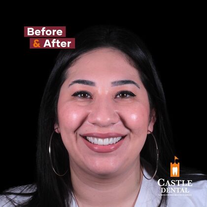 Porcelain Veneers Case 5 - After