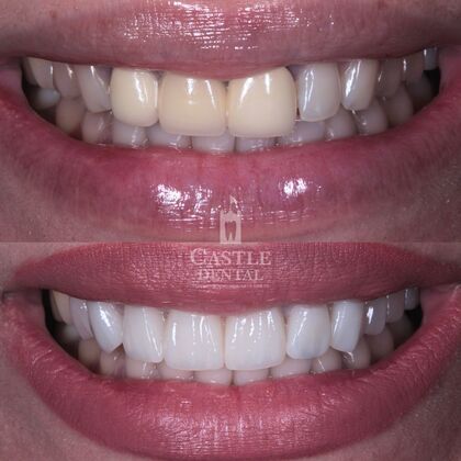 Porcelain Veneers: Case 5