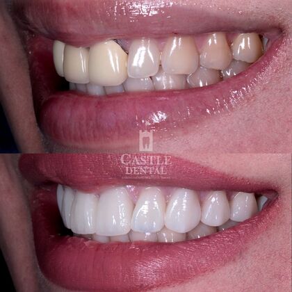 Porcelain Veneers: Case 5