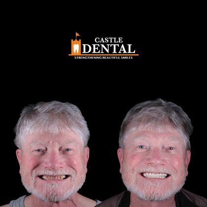 Full Mouth Restoration  Case 2