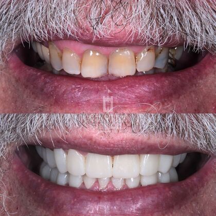 Full Mouth Restoration : Case 3