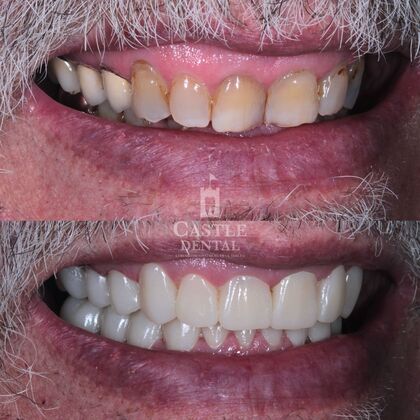 Full Mouth Restoration : Case 3