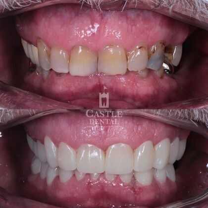 Full Mouth Restoration : Case 3