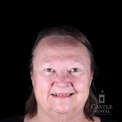 Zirconia Crowns Case 4 - Before