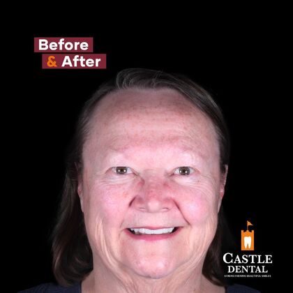 Zirconia Crowns Case 4 - After