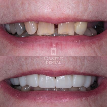 Zirconia Crowns: Case 4