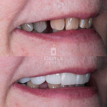 Zirconia Crowns: Case 4