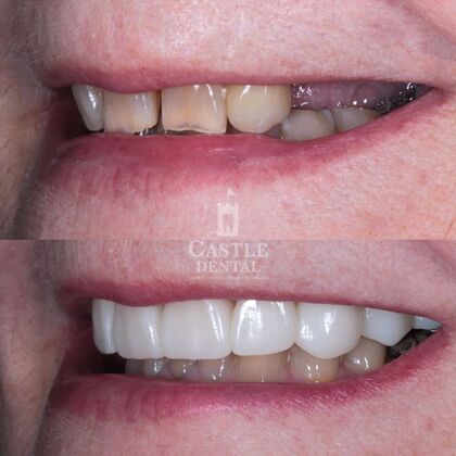 Zirconia Crowns: Case 4