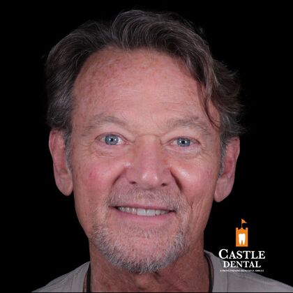 Full Mouth Restoration  Case 6  - Before