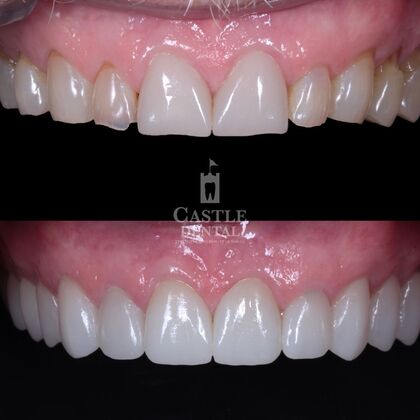 Full Mouth Restoration : Case 6