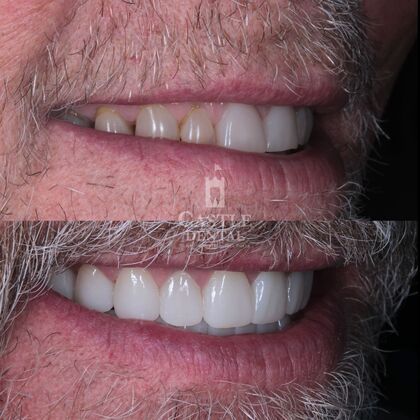 Full Mouth Restoration : Case 6