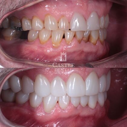 Full Mouth Restoration : Case 6
