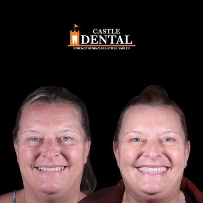 Porcelain Veneers Case 7