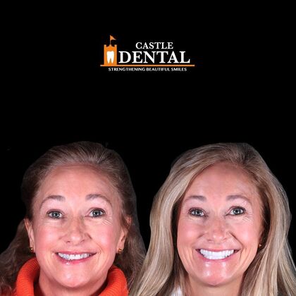 Zirconia Crowns Case 8