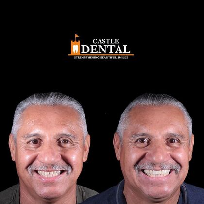 Zirconia Crowns Case 10