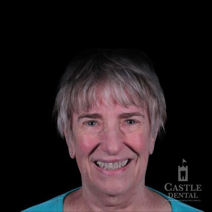 Full Mouth Restoration  Case 11 - Before