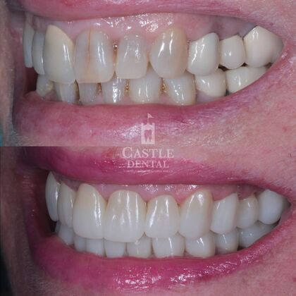 Full Mouth Restoration : Case 11